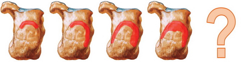 П'ять морфологічних типів деформації Хаглунд на прикладі правої п'яткової кістки (вид ззаду) зліва направо - верхній, верхньо-латеральний, по дузі, тотальний, атиповий