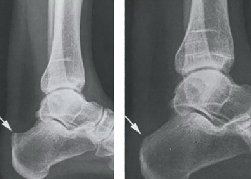 Стан п'яткової кістки до операції (зліва) і після видалення деформації Хаглунда (праворуч)