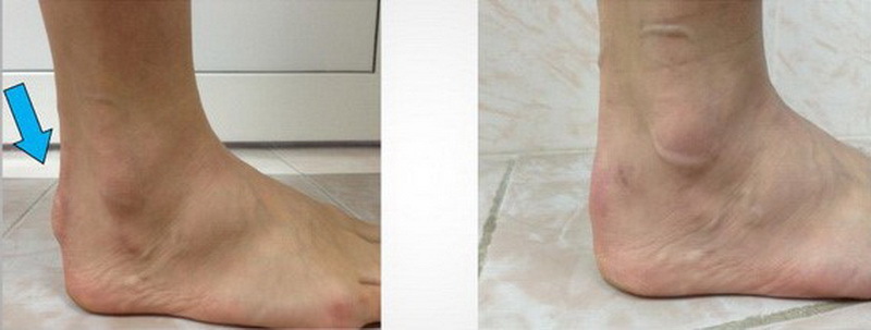 Косметичний ефект до операції (зліва) і після видалення деформації Хаглунда через 6 місяців (праворуч)